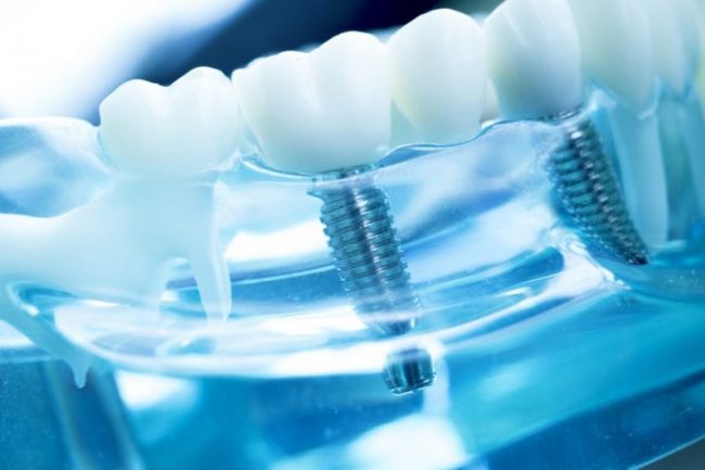Implantul dentar 1 cubic dent Bucuresti sector 2 Implantul dentar 1 cubic dent Bucuresti sector 2