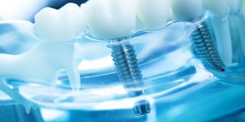 Implantul dentar 1 cubic dent Bucuresti sector 2 Implantul dentar 1 cubic dent Bucuresti sector 2