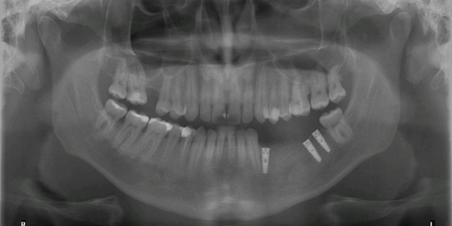 radiografie implant la cubicdent radiografie implant la cubicdent Bucuresti Sector 2