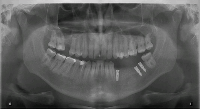 radiografie implant la cubicdent radiografie implant la cubicdent Bucuresti Sector 2
