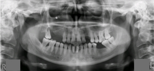Caz clinic etapizat in tratarea bolii parodontale caz stomatologic tratament boala paradontala Caz clinic etapizat in tratarea bolii parodontale blog sectiune