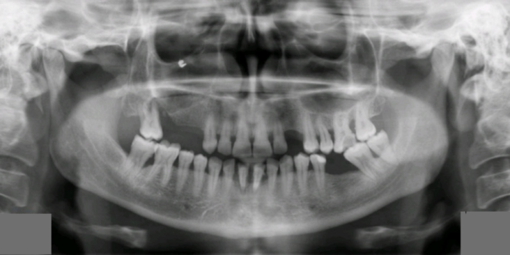 Caz clinic etapizat in tratarea bolii parodontale caz stomatologic tratament boala paradontala Caz clinic etapizat in tratarea bolii parodontale blog sectiune