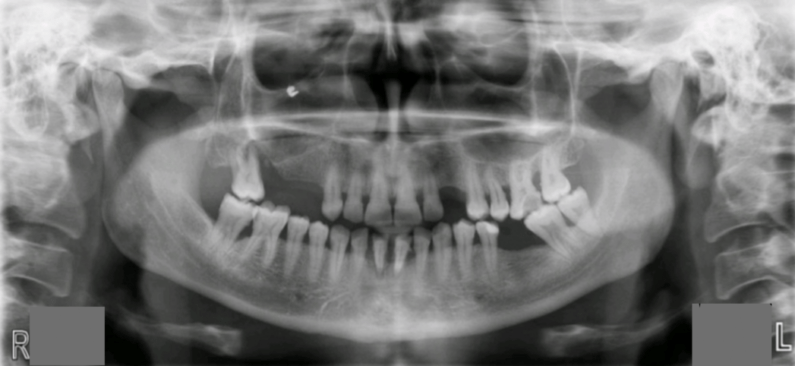 Caz clinic etapizat in tratarea bolii parodontale blog sectiune