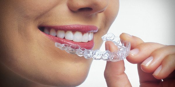Aparat dentar Invisalign 1 Aparatul dentar INVISALIGN la clinica denatara cubic dent Bucuresti sector 2