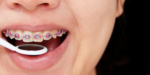 Aparat dentar ortodontic 1Tipuri de aparate ortodontice Aparat dentar ortodontic 1 Tipuri de aparate ortodontice Aparat dentar ortodontic 1