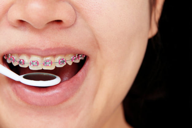 Aparat dentar ortodontic 1Tipuri de aparate ortodontice Aparat dentar ortodontic 1 Tipuri de aparate ortodontice Aparat dentar ortodontic 1
