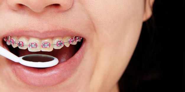 Tratamentul ortodontic Aparat dentar ortodontic Tratamentul ortodontic Aparat dentar ortodontic