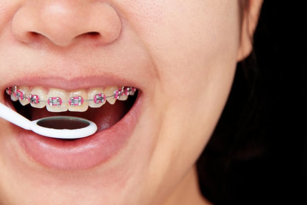 Tratamentul ortodontic Aparat dentar ortodontic Tratamentul ortodontic Aparat dentar ortodontic