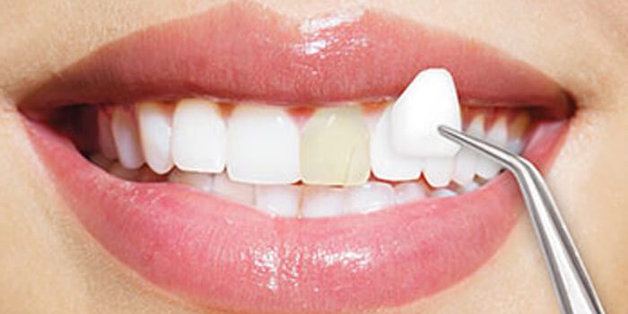 Ce sunt fatetele dentare? Fatete dentare din portelan Ce sunt fatetele dentare? Fatete dentare din portelan