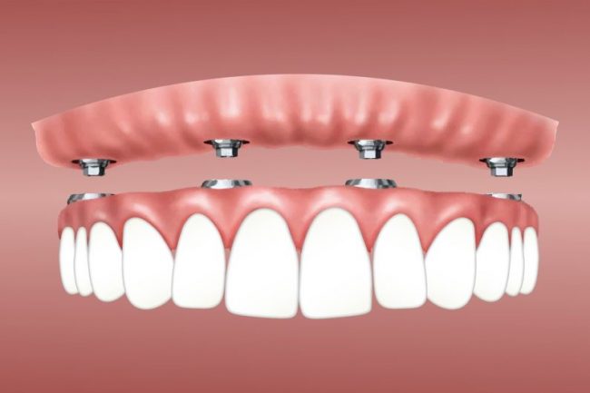 Supraprotezare pe implant Proteza dentara pe implanturi Supraprotezare pe implant