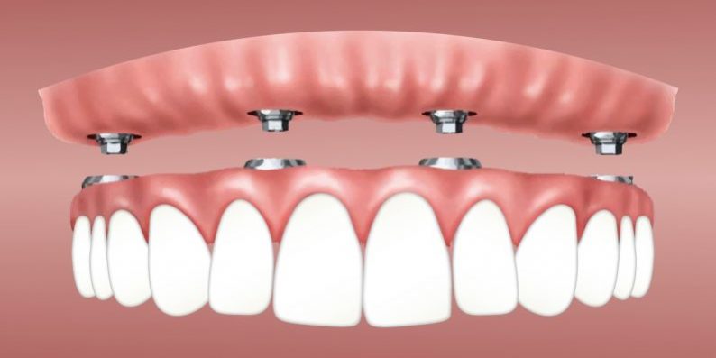 Supraprotezare pe implant Proteza dentara pe implanturi Supraprotezare pe implant