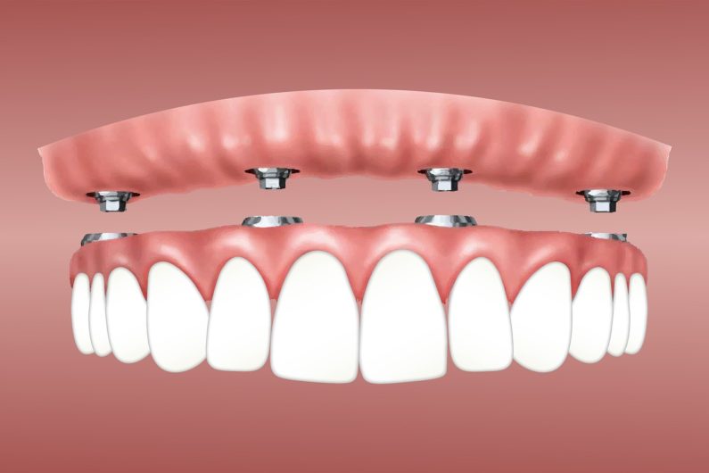 Proteza dentara pe implanturi Supraprotezare pe implant