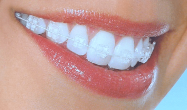 aparat dentar ceramic invisibil Cum imi aleg aparatul dentar? aparat dentar ceramic invisibil