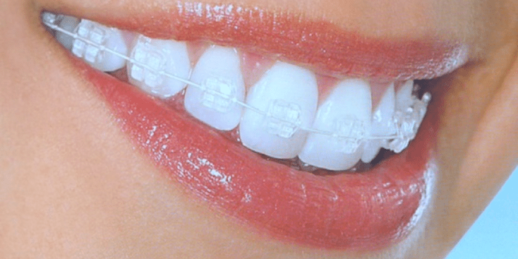 aparat dentar ceramic invisibil Cum imi aleg aparatul dentar? aparat dentar ceramic invisibil