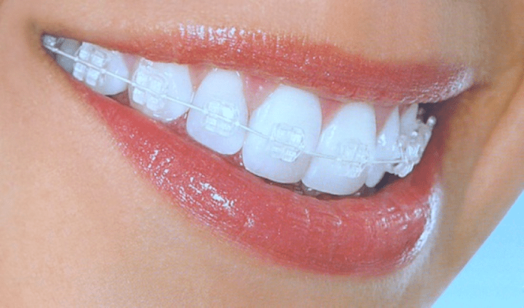 Cum imi aleg aparatul dentar? aparat dentar ceramic invisibil