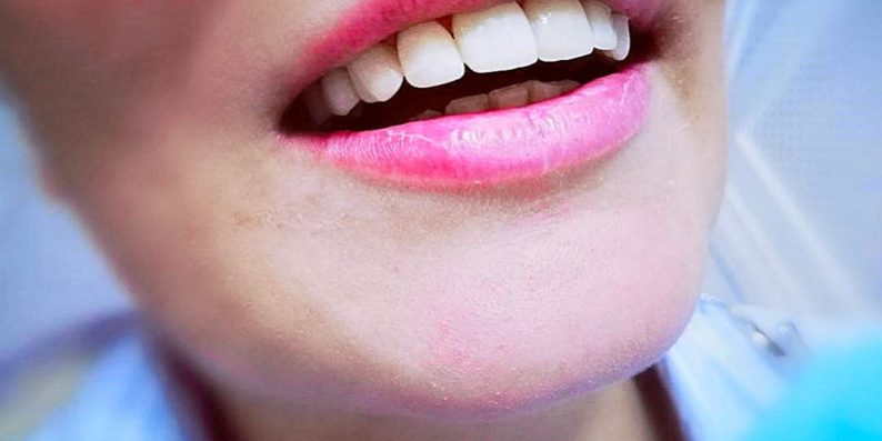 Aplicare fatete dentare cabinet stomatologic bucuresti sector 2 Aplicarea fatetelor dentare - caz clinic - Aplicare fatete dentare cabinet stomatologic bucuresti sector 2