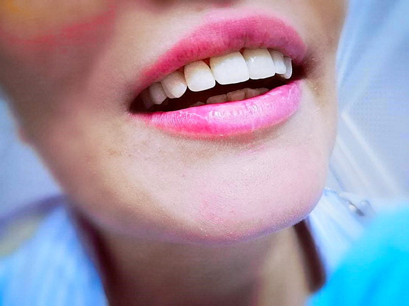 Aplicarea fatetelor dentare - caz clinic - Aplicare fatete dentare cabinet stomatologic bucuresti sector 2