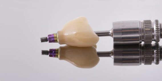 Implant dentar bucuresti cabinet stomatologic Cat costa un implant dentar in 2021? Implant dentar bucuresti cabinet stomatologic