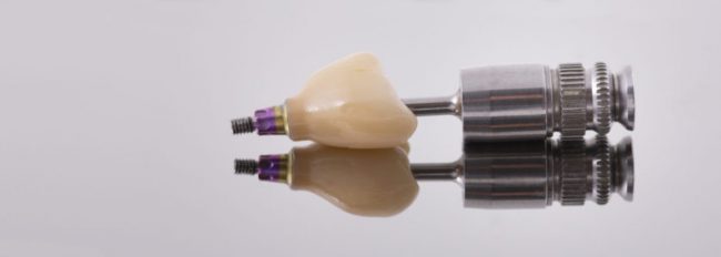 Implant dentar bucuresti cabinet stomatologic Cat costa un implant dentar in 2021? Implant dentar bucuresti cabinet stomatologic