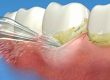 Cum sa ai grija de implanturile dentare? Igienizare implant dentar bucuresti