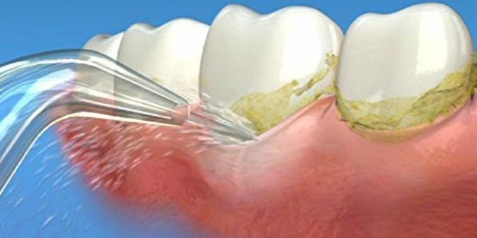 Cum sa ai grija de implanturile dentare? Igienizare implant dentar bucuresti Cum sa ai grija de implanturile dentare? Igienizare implant dentar bucuresti