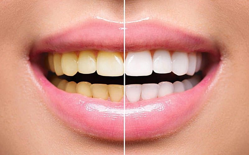 Estetica dentara / Albirea dentara Albire dentara concentrate CUBIC DENT Bucuresti sector 2