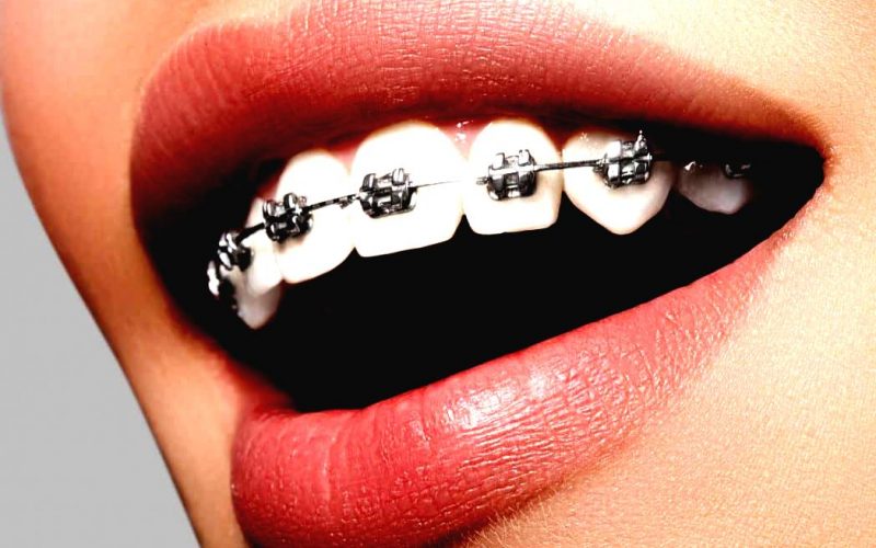 Parodontologie Profilaxie dentara boala parodontologica profilaxie dentara stomatologie 1 Aparat ortodontic boost
