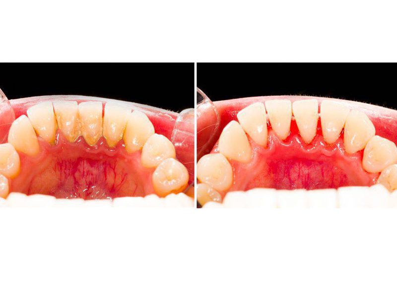 Profilaxie dentara Detartraj igienizare dentara