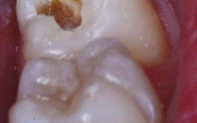 Caria dentara carii dentare chirurgie dentara Cubic Dent Sector 2 Bucuresti