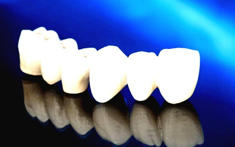 CUBIC DENT - dental servicii Coroana dentara portelan boost - CUBIC DENT - Cabinet