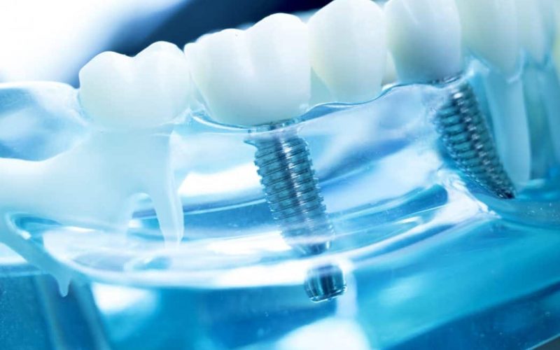 Implant dentar dental servicii Implant-dentar urgenta stomatologica-bucuresti