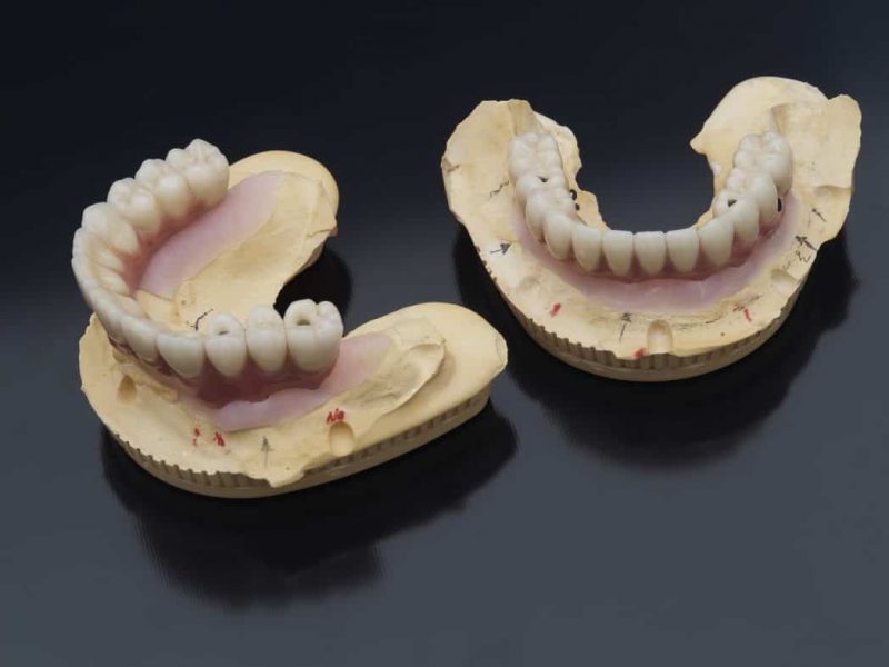 Supraprotezarea pe implanturi dental servicii Supraprotezare pe implanturi