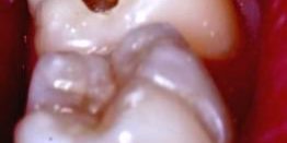 Chirurgie dentara dental servicii caria dentara 3 Caria dentara tratament in oglinda cabinet stomatologic CUBIC Bucuresti Chirurgie dentara dental servicii caria dentara 3 Caria dentara tratament in oglinda cabinet stomatologic CUBIC Bucuresti