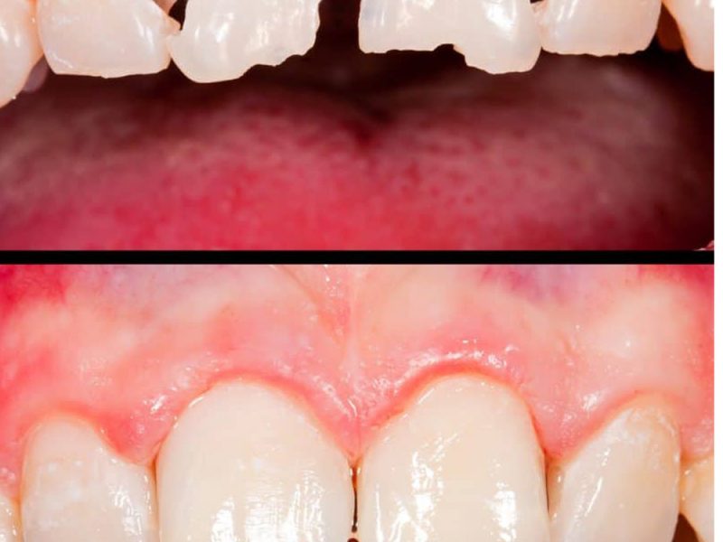 Fatete dentare clinica CUBIC DENT Bucuresti Sector 2