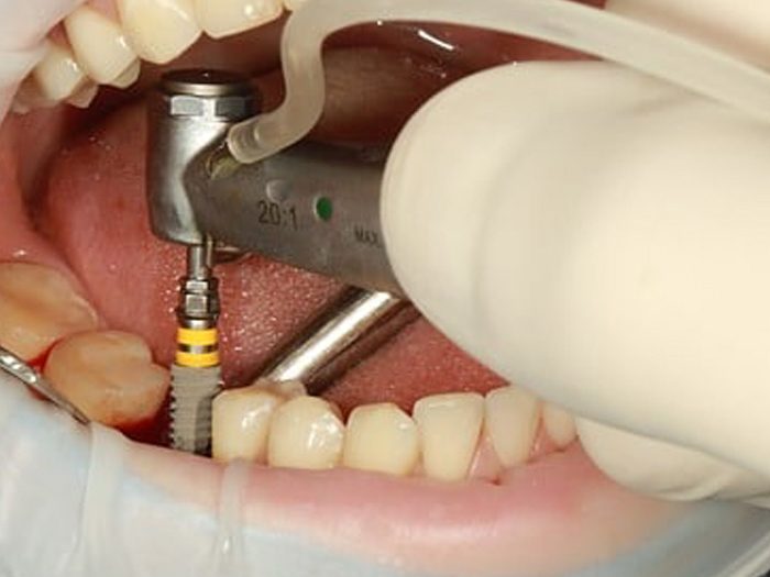 Implant dentar implant dentar la Cubic Dent Bucuresti Sector 2