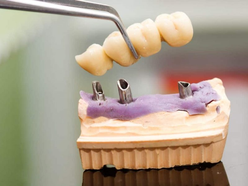 Implant dentar stomatologie Cubic Dent 2