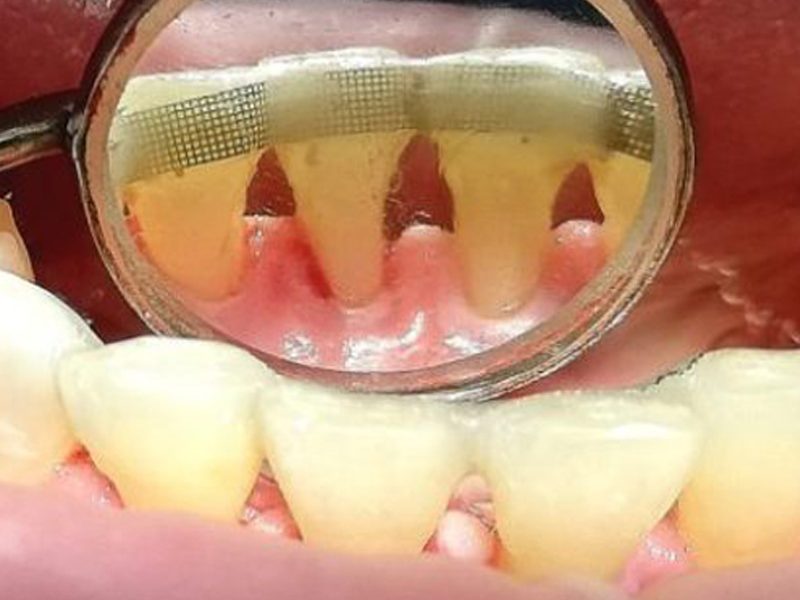 Profilaxie dentara boala parodontala profilaxie dentara stomatologie