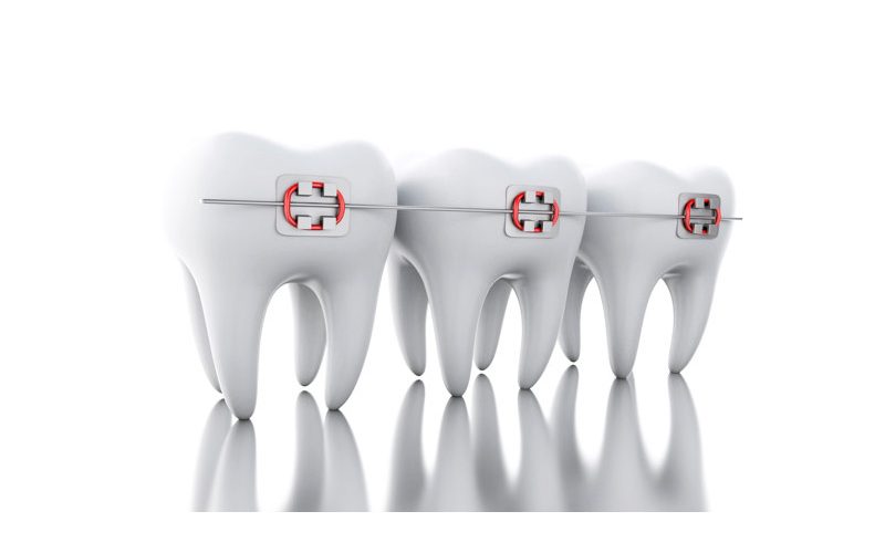 Ortodontie / Aparat dentar servicii ortodontie
