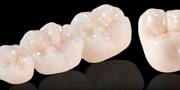 coroana dentara ceramice zirconiu bucuresti sector 2 coroana dentara ceramice zirconiu bucuresti sector 2
