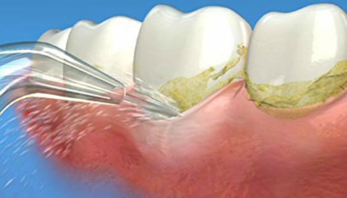 Igienizare implant dentar bucuresti PS Igienizare implant dentar bucuresti PS