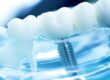 Implant dentar 1 PS