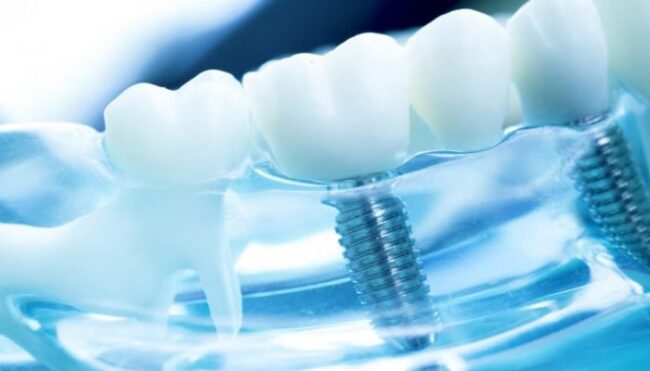 Implant dentar 1 PS Implant dentar 1 PS