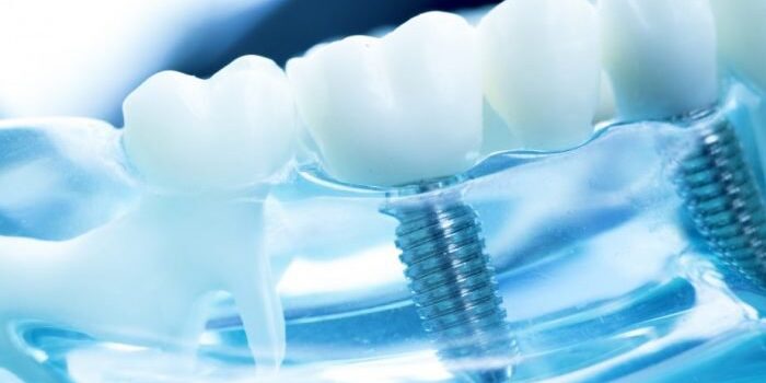 Implant dentar 1 PS Implant dentar 1 PS