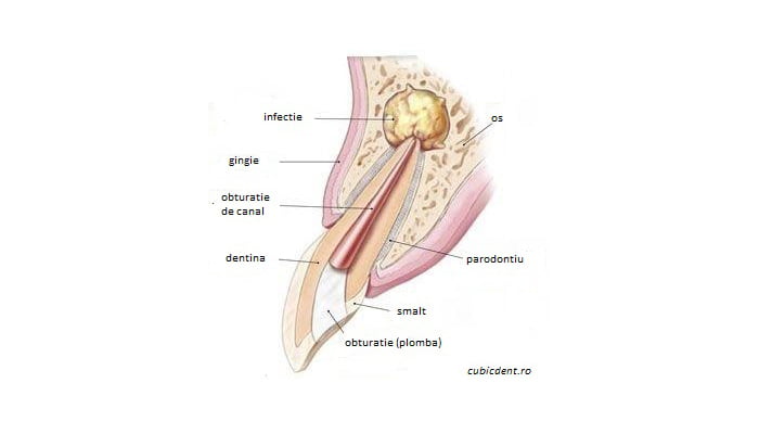 Rezectie apicala cubicdent PS Chirurgie dentara Rezectie apicala cubicdent PS