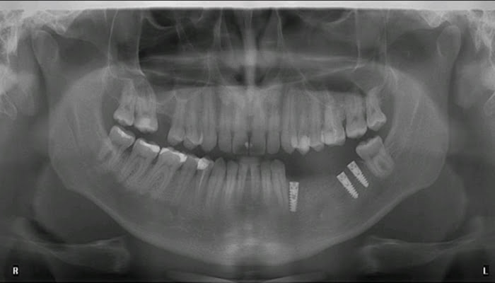 radiografie implant la cubicdent PS Implant dentar radiografie implant la cubicdent PS
