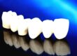 punte dentara zirconiu