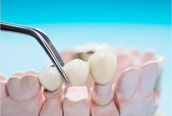 punte dentara bucuresti - Ce este puntea dentara? Pret si recomandari