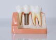 implant.articol