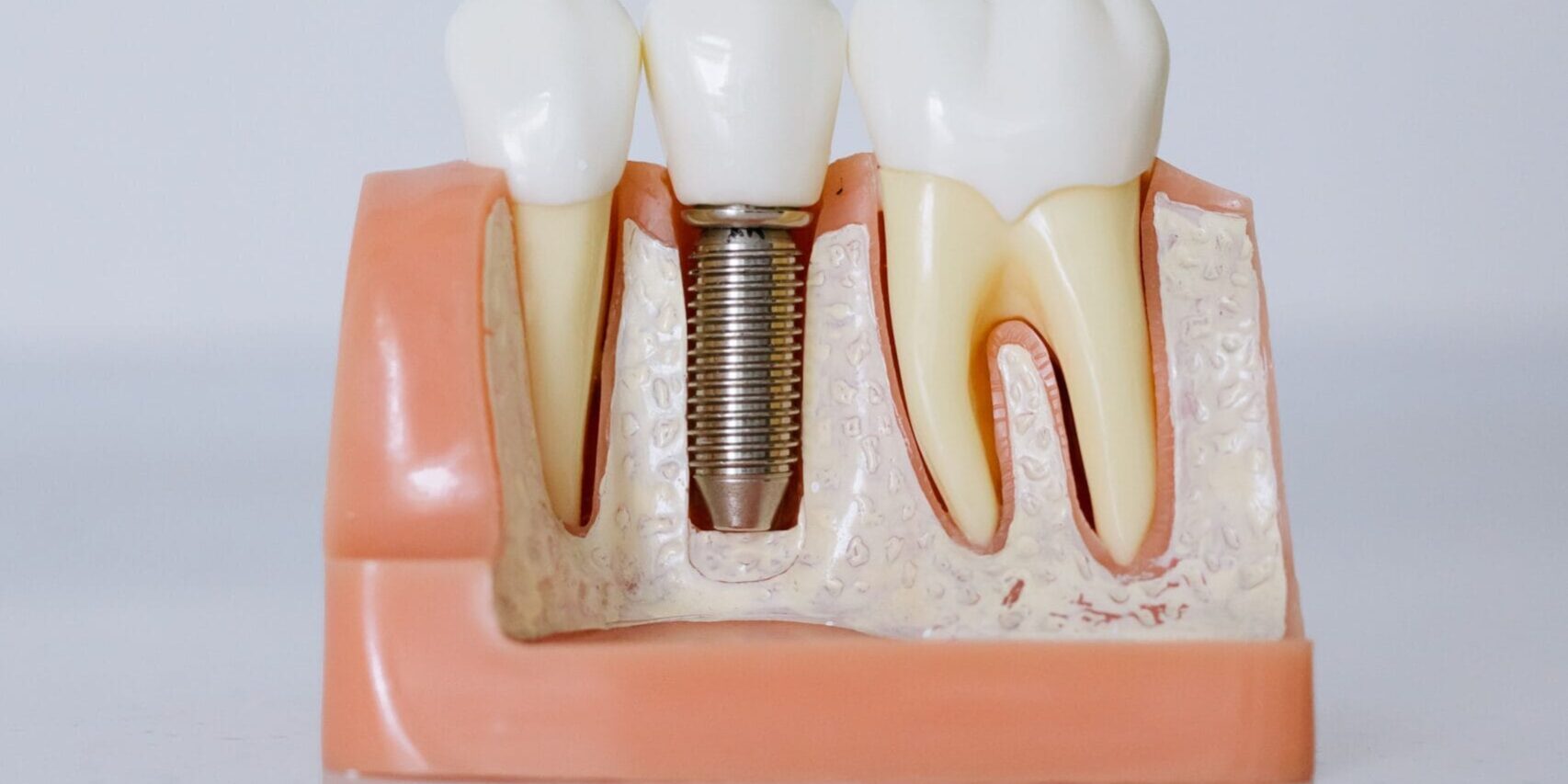 implant.articol implant.articol