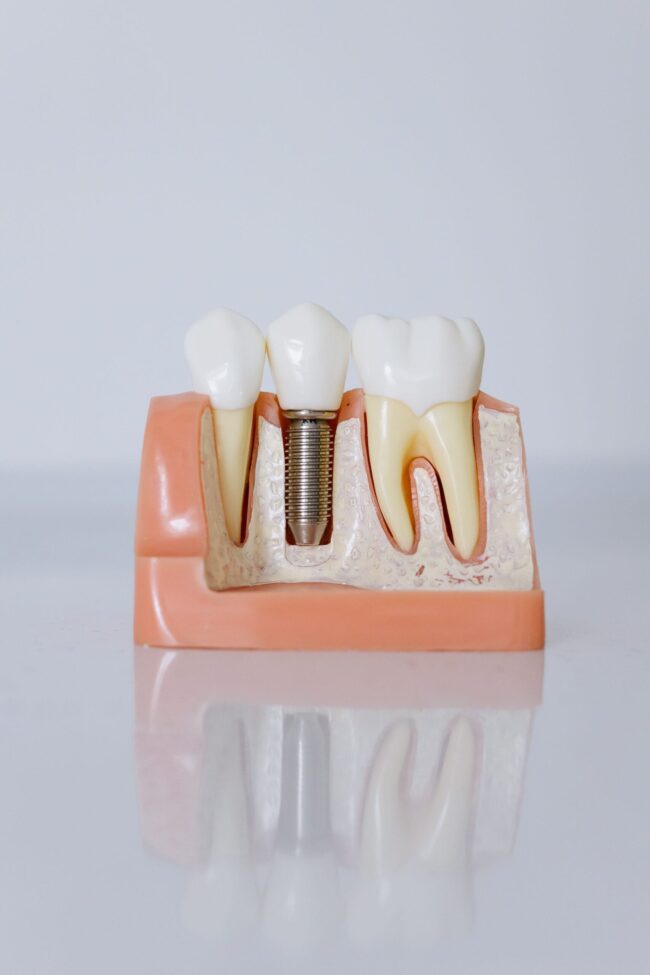 implant.articol implant.articol